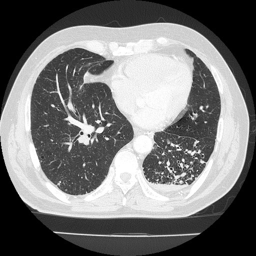 File:Silicosis, progressive massive fibrosis, and putty kidney ...