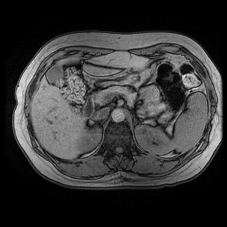 Insulinoma | Image | Radiopaedia.org