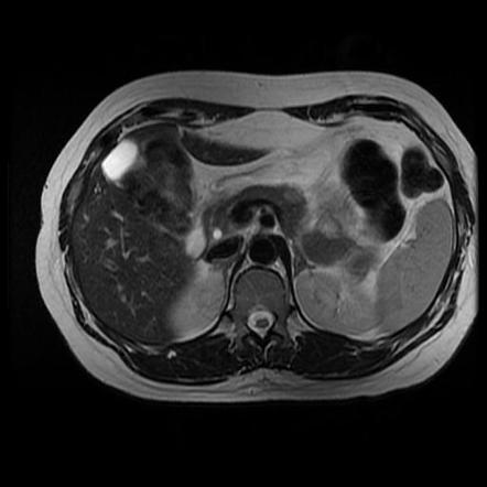 Insulinoma | Radiology Case | Radiopaedia.org