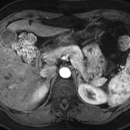 Insulinoma | Image | Radiopaedia.org