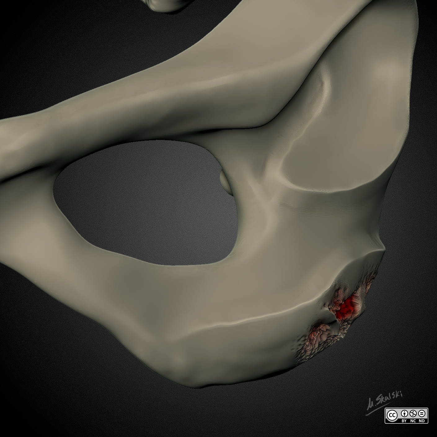 Enthesopathy Vs Enthesitis (diagram) | Image | Radiopaedia.org