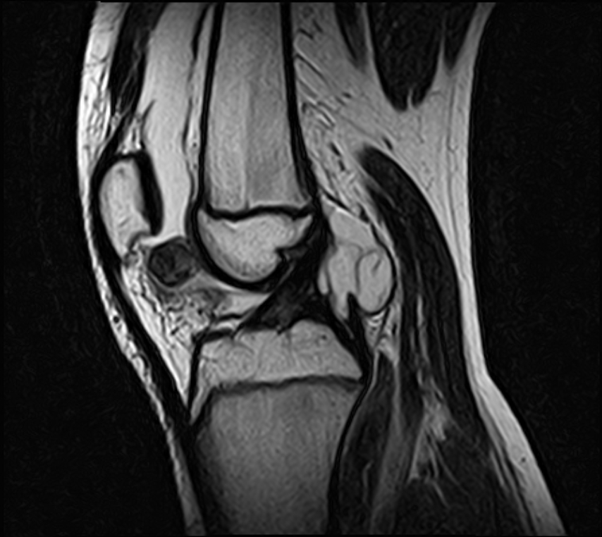 Intracapsular chondroma - knee | Image | Radiopaedia.org