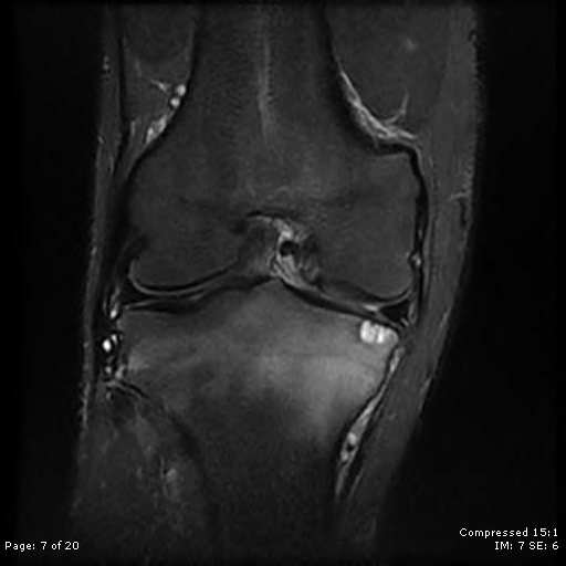 Chondroblastoma | Image | Radiopaedia.org