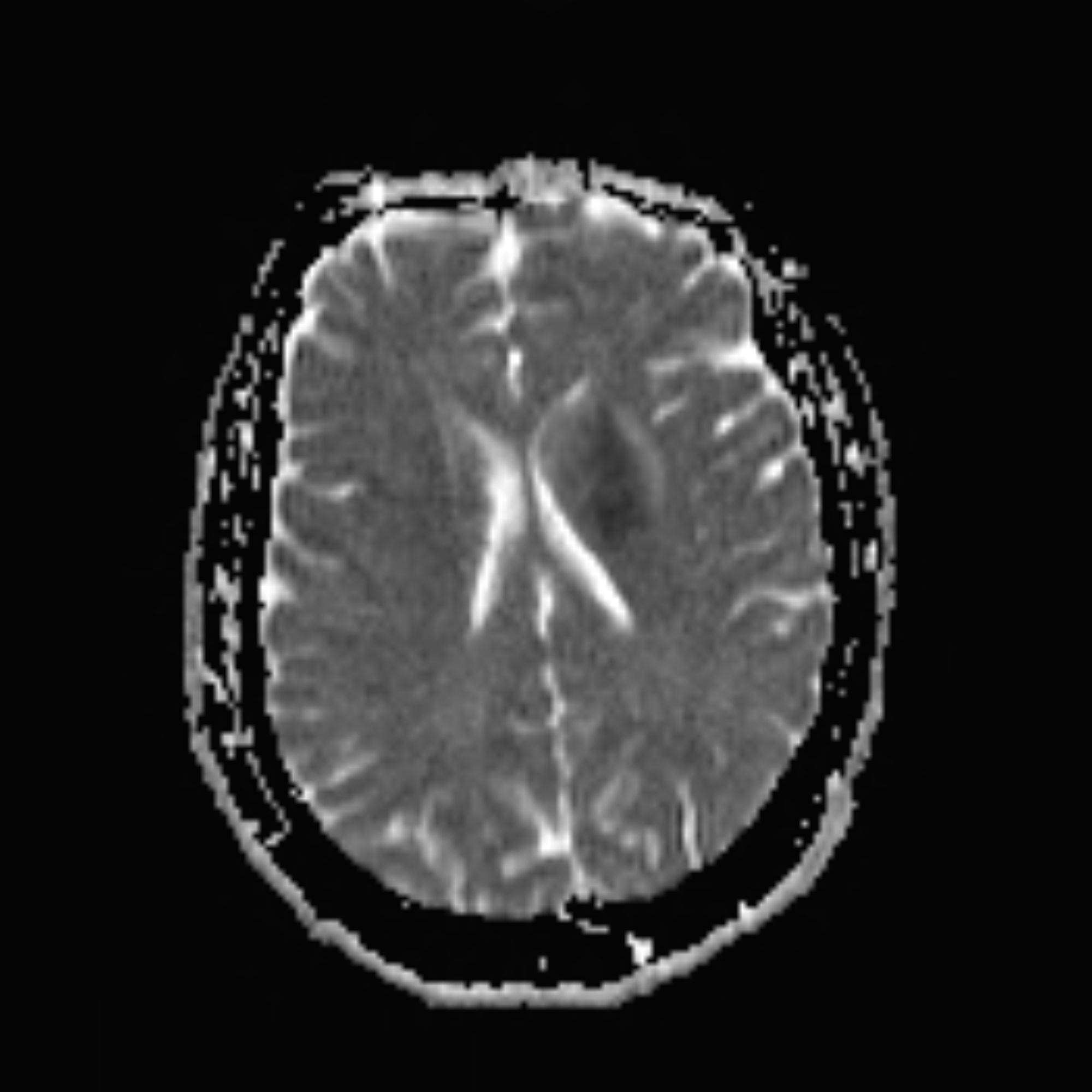 Recurrent artery of Heubner infarct | Image | Radiopaedia.org