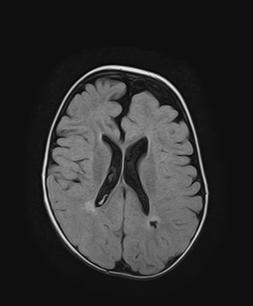 Periventricular leucomalacia - frontal arachnoid cyst | Radiology Case ...