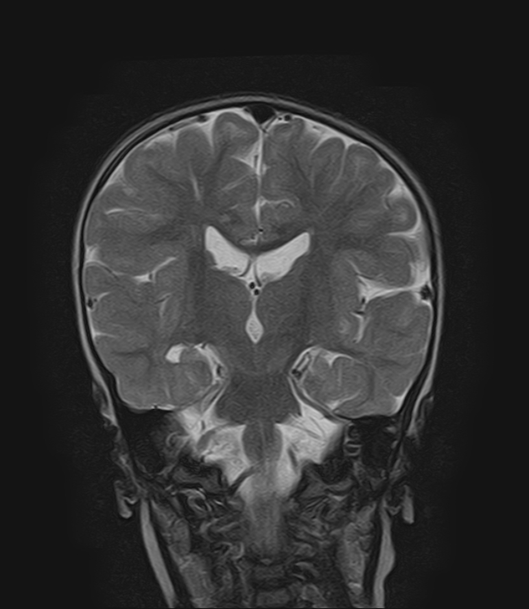 Periventricular leucomalacia - frontal arachnoid cyst | Image ...