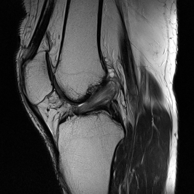 Anterior cruciate ligament mucoid degeneration | Radiology Reference ...