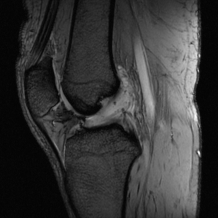 Anterior cruciate ligament mucoid degeneration | Image | Radiopaedia.org