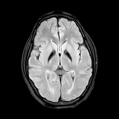 Pantothenate kinase-associated neurodegeneration | Image | Radiopaedia.org