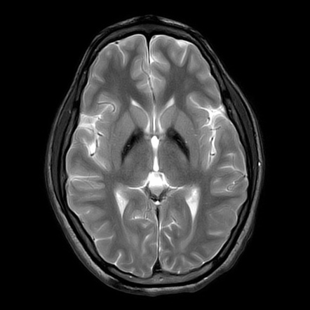 Pantothenate kinase-associated neurodegeneration | Image | Radiopaedia.org