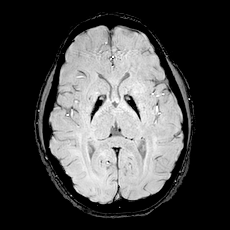 Pantothenate kinase-associated neurodegeneration | Image | Radiopaedia.org