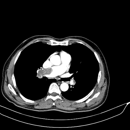 Acute pulmonary embolism | Radiology Case | Radiopaedia.org