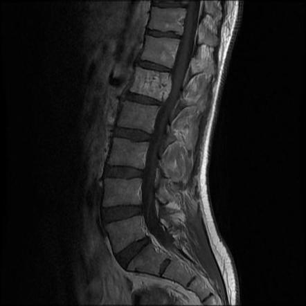 Aggressive vertebral hemangioma with pathological fracture | Image ...