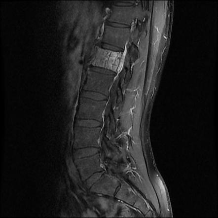 Aggressive vertebral hemangioma with pathological fracture | Radiology ...