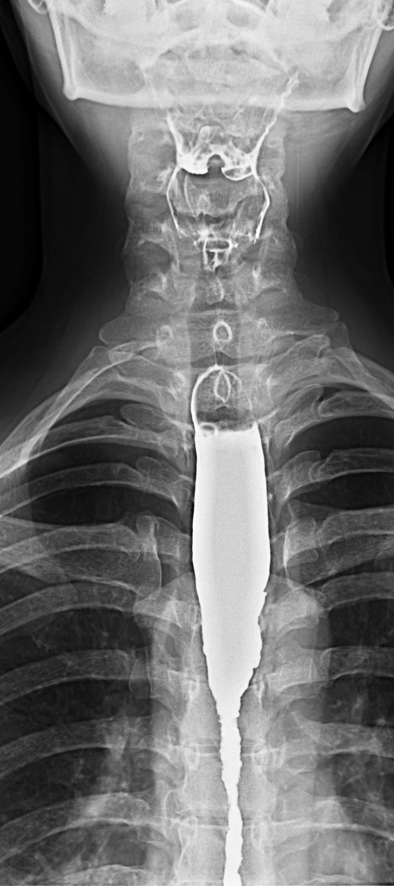 X Ray Barium Side Effects