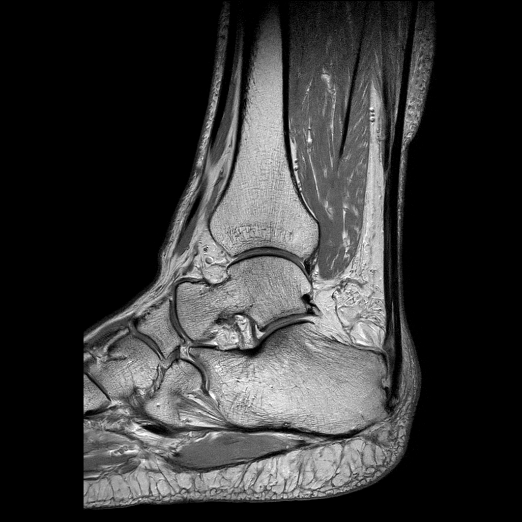 Achilles enthesitis and retrocalcaneal bursitis Image