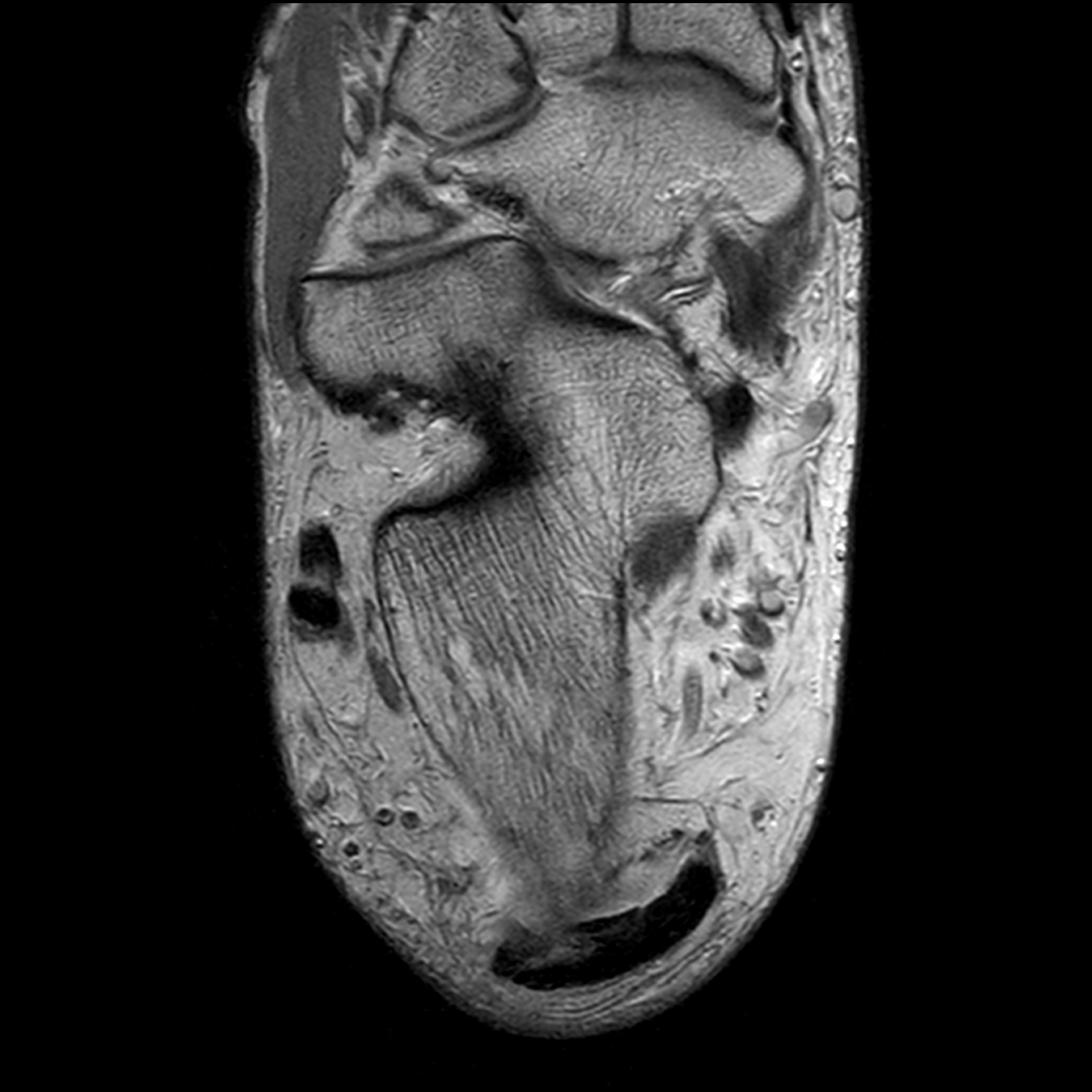 Achilles Enthesitis And Retrocalcaneal Bursitis Image