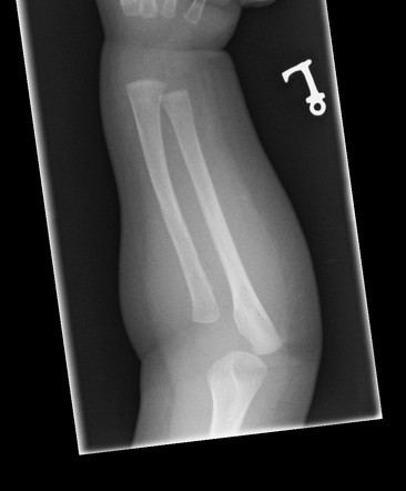 NAI - abusive head trauma and rib fractures | Image | Radiopaedia.org