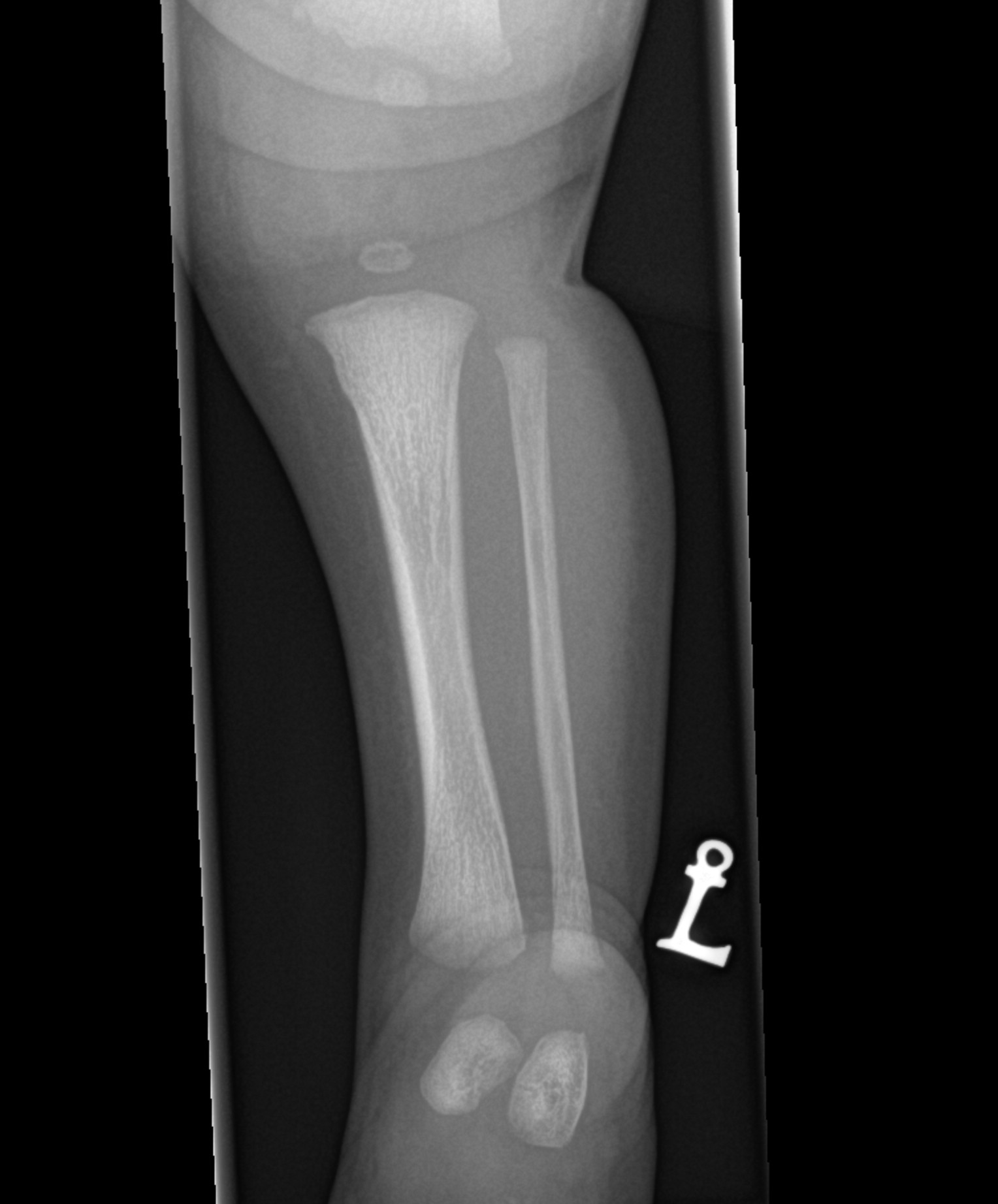 Metaphyseal corner fracture | Image | Radiopaedia.org