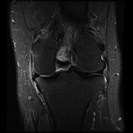 Horizontal medial meniscal tear with displaced flap into inferior ...