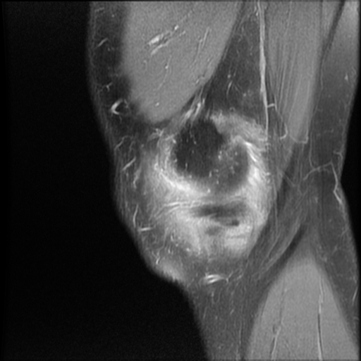 Horizontal medial meniscal tear with displaced flap into inferior ...