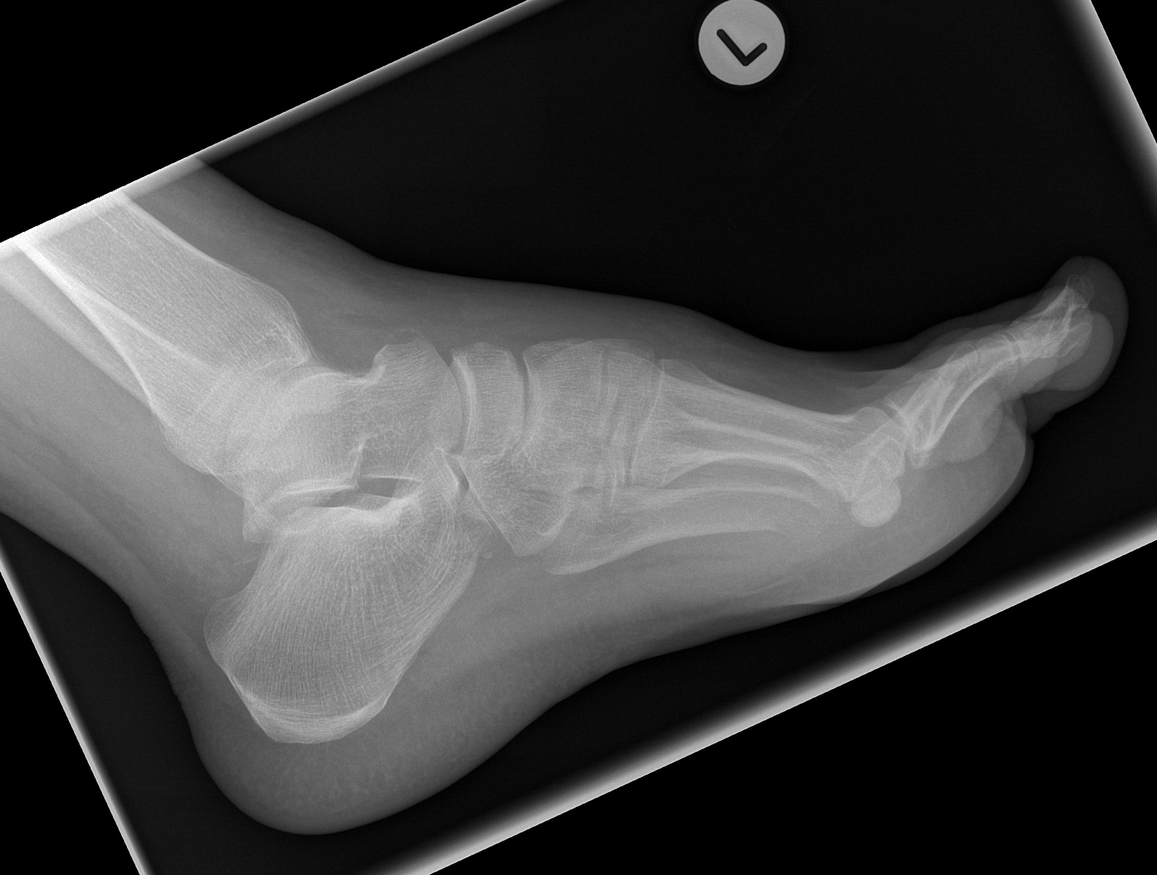 Complex regional pain syndrome following Cedell fracture | Image ...