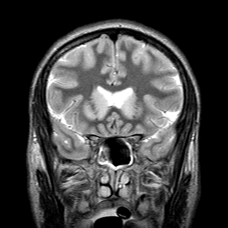 Hypoxic-ischemic brain damage | Image | Radiopaedia.org