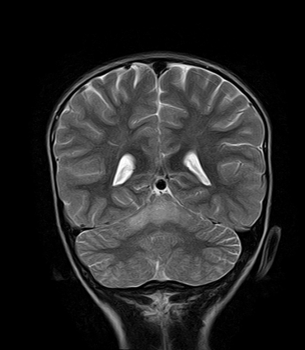 Acute cerebellitis | Image | Radiopaedia.org