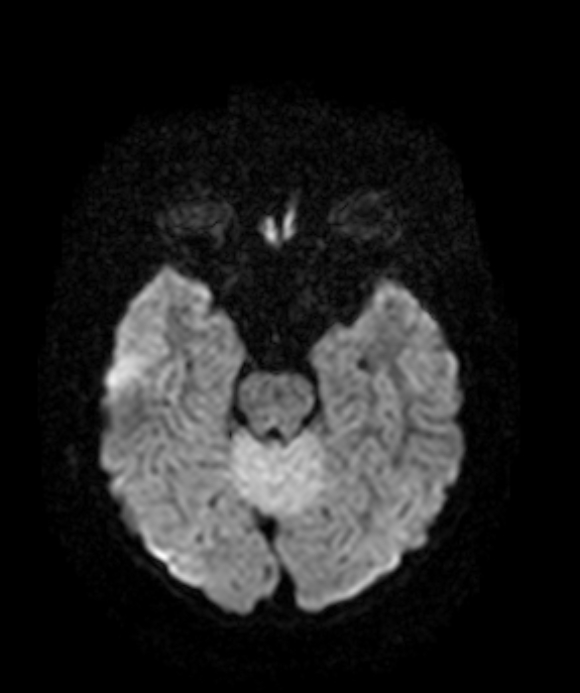 Acute cerebellitis | Image | Radiopaedia.org