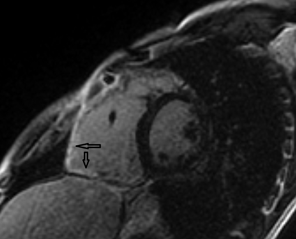 Arrhythmogenic Right Ventricular Cardiomyopathy | Image | Radiopaedia.org