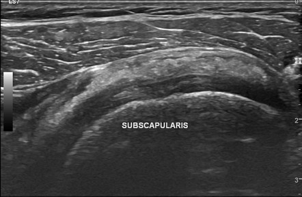 Subscapularis calcific tendinosis | Radiology Case | Radiopaedia.org