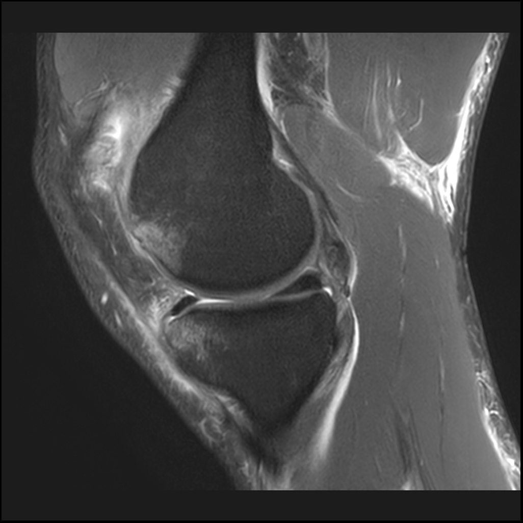 Hyperextension knee injury - posteromedial and posterolateral corner ...