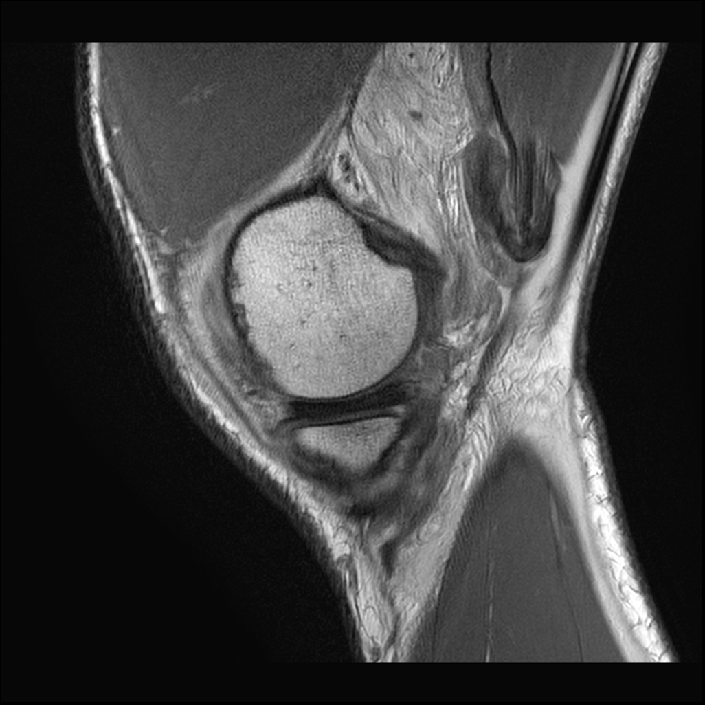 Hyperextension knee injury - posteromedial and posterolateral corner ...