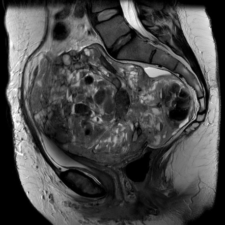 Uterine leiomyosarcoma | Radiology Reference Article | Radiopaedia.org