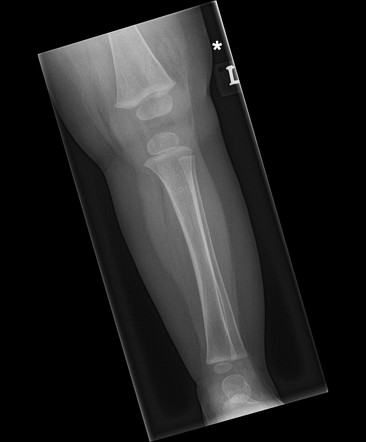 Distal femoral buckle fracture | Radiology Case | Radiopaedia.org