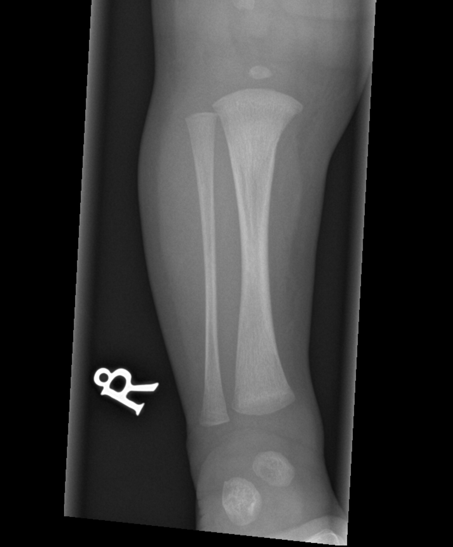 Normal skeletal survey - 1-month-old | Image | Radiopaedia.org