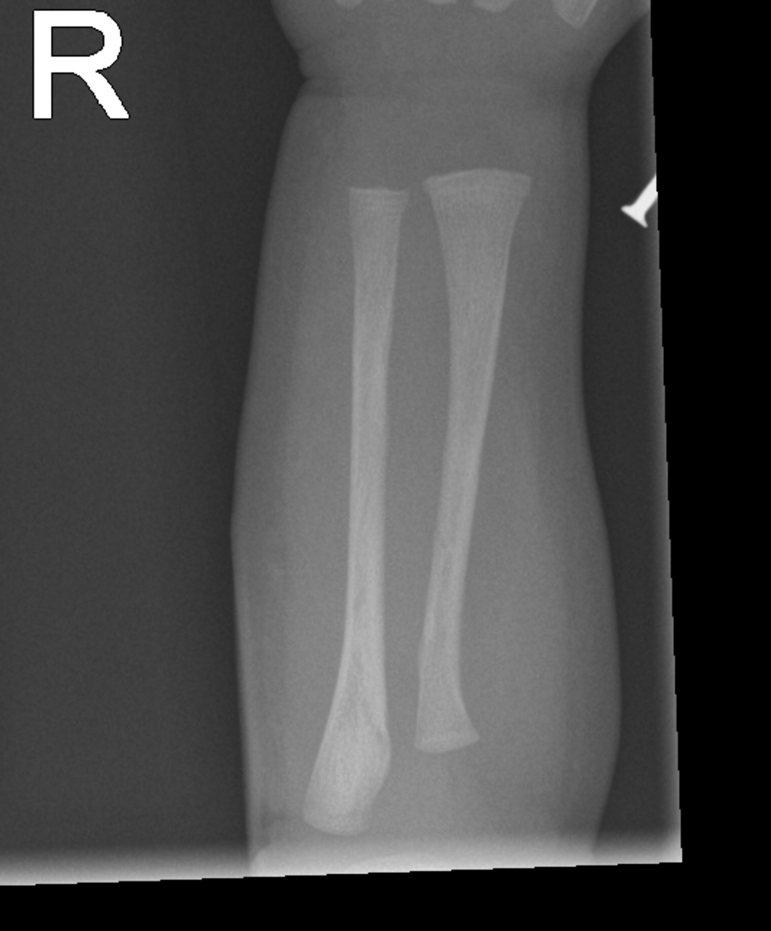 Normal skeletal survey - 1-month-old | Image | Radiopaedia.org