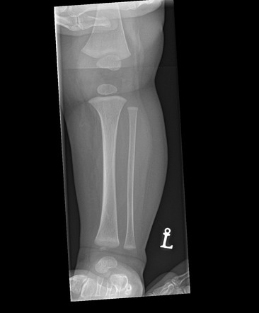 Normal skeletal survey - 6 months | Image | Radiopaedia.org