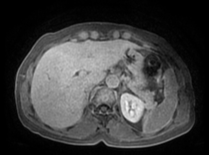 Giant hepatic hemangioma | Image | Radiopaedia.org