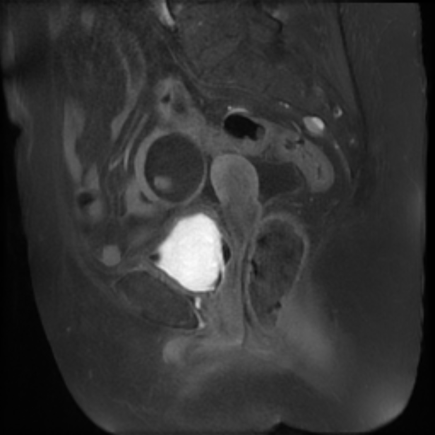 Appendicular Mucocele With Pseudomyxoma Peritonei | Image | Radiopaedia.org