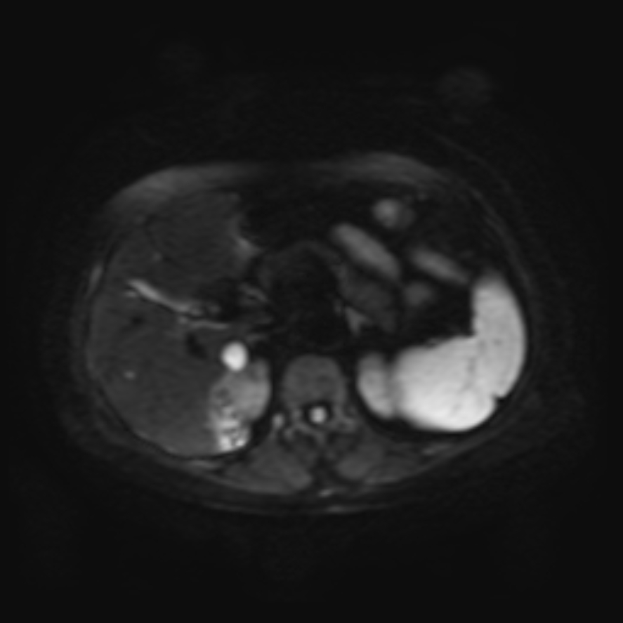 Appendicular Mucocele With Pseudomyxoma Peritonei | Image | Radiopaedia.org