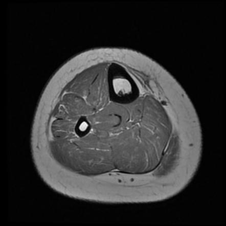 Osteochondroma - tibia | Image | Radiopaedia.org