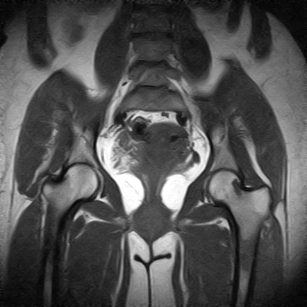 Ollier disease | Image | Radiopaedia.org