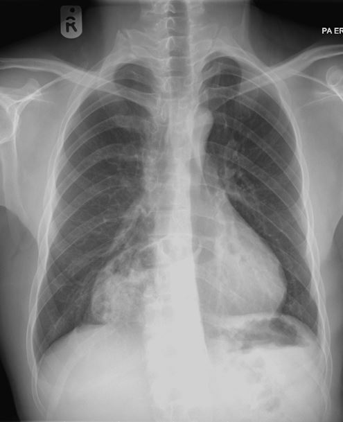 Congenital Diaphragmatic Hernia - Morgagni Hernia 