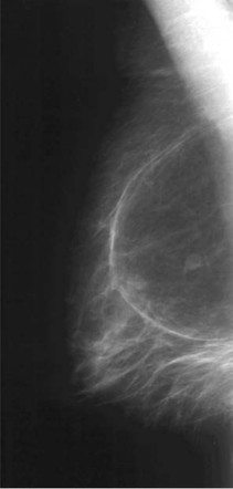 Breast Lipoma Radiology Reference Article Radiopaedia Org