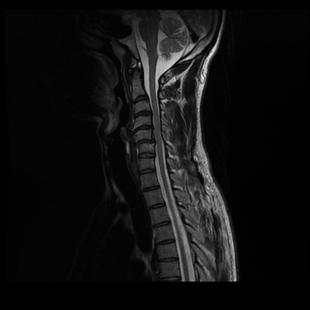 Cervical unilateral facet joint dislocation | Radiology Case ...