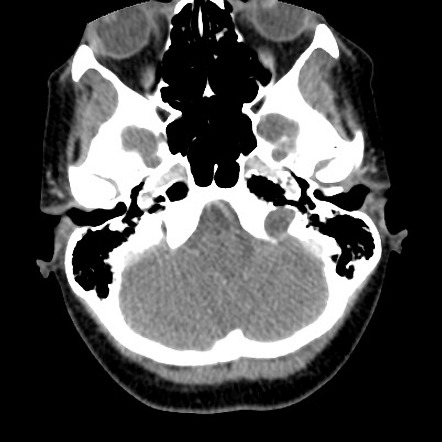 Jugular foramen schwannoma | Radiology Case | Radiopaedia.org