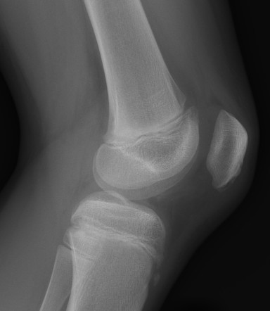 Patella sleeve avulsion | Radiology Case | Radiopaedia.org