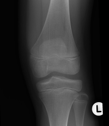 Patella sleeve avulsion | Image | Radiopaedia.org