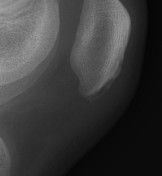 Patellar sleeve fracture | Radiology Reference Article | Radiopaedia.org